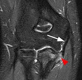 Elbow - Ligament tears​ - Orthopedic