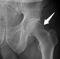 Hip - Femoroacetabular Impingement - Orthopedic