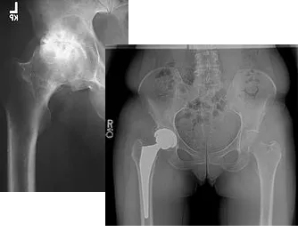 Hip - Stiffness and loss of range of motion - Orthopedic