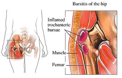 Hip - Trochanteric Bursitis - Orthopedic