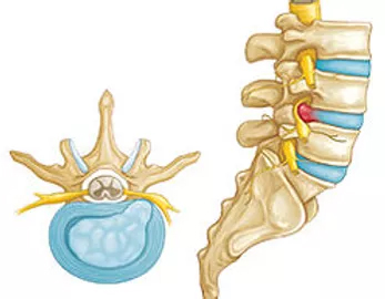 Pfisterer Orthopaedics - Spine Conditions